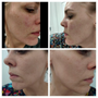 Before and after results with high-frequency facial wand
